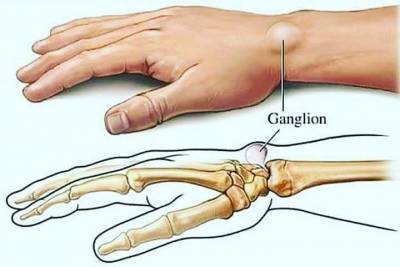 Hand Tumors